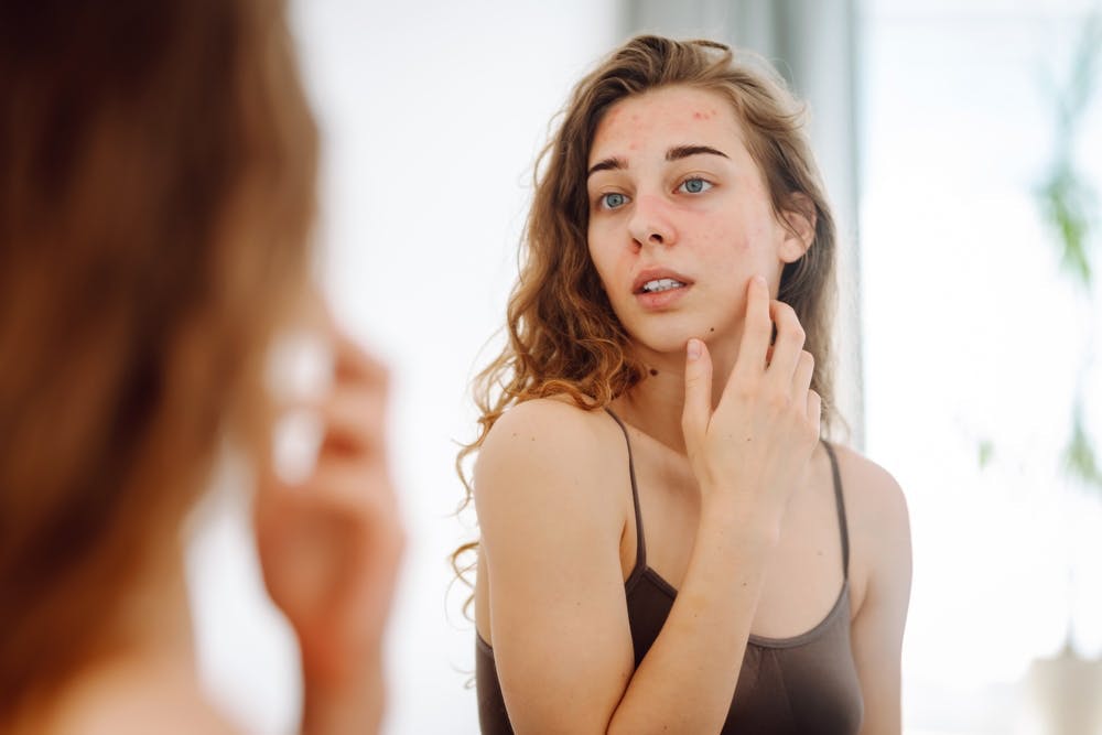 A young woman looking at her reflection in the mirror and touching her rash 
